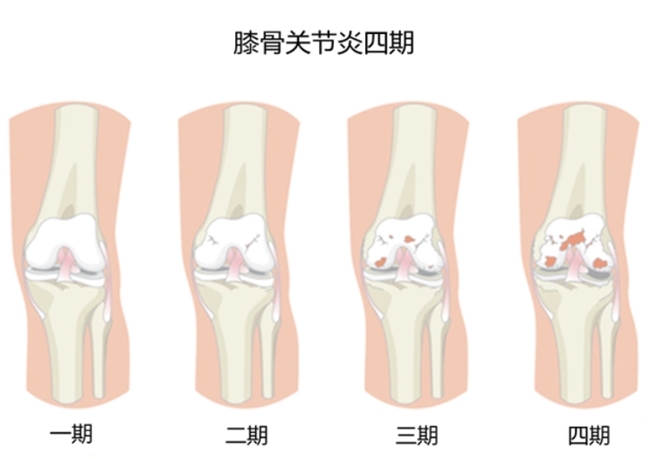 膝关节骨关节炎怎么治疗？西乐葆带来长效舒缓
