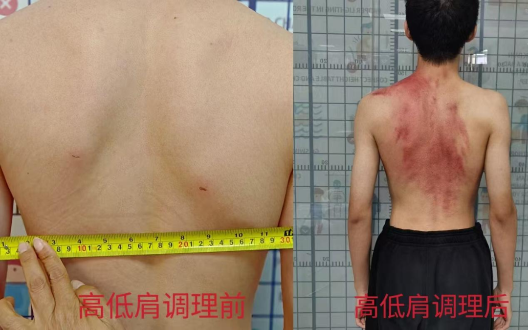 青少年脊柱守护行动——挺起少年脊梁